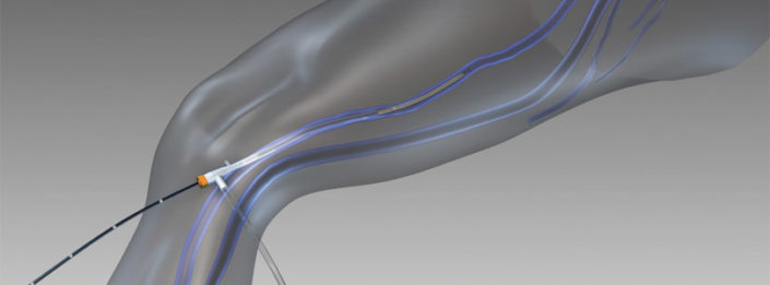 Krampfadern schonend und sanft entfernen – Nürnberg – Dr. med. Jörg ...